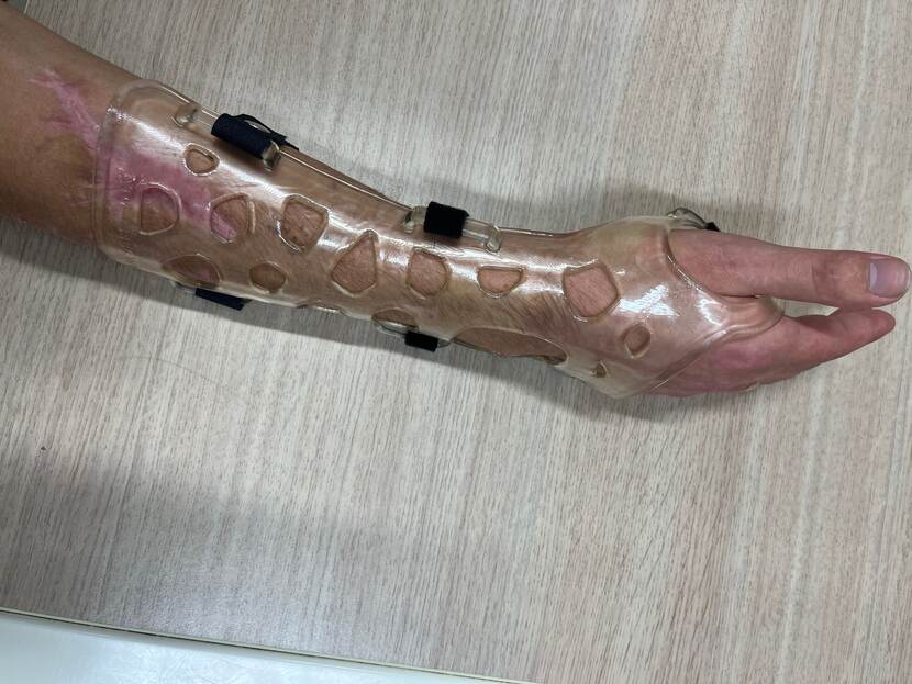 Onderarm met littekens in doorzichtige en deels open spalk.